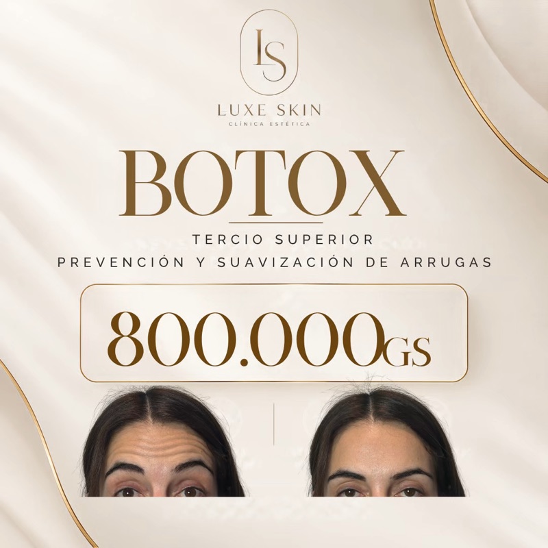 Botox tercio superior: prevención y suavización de arrugas, 800.000 Gs